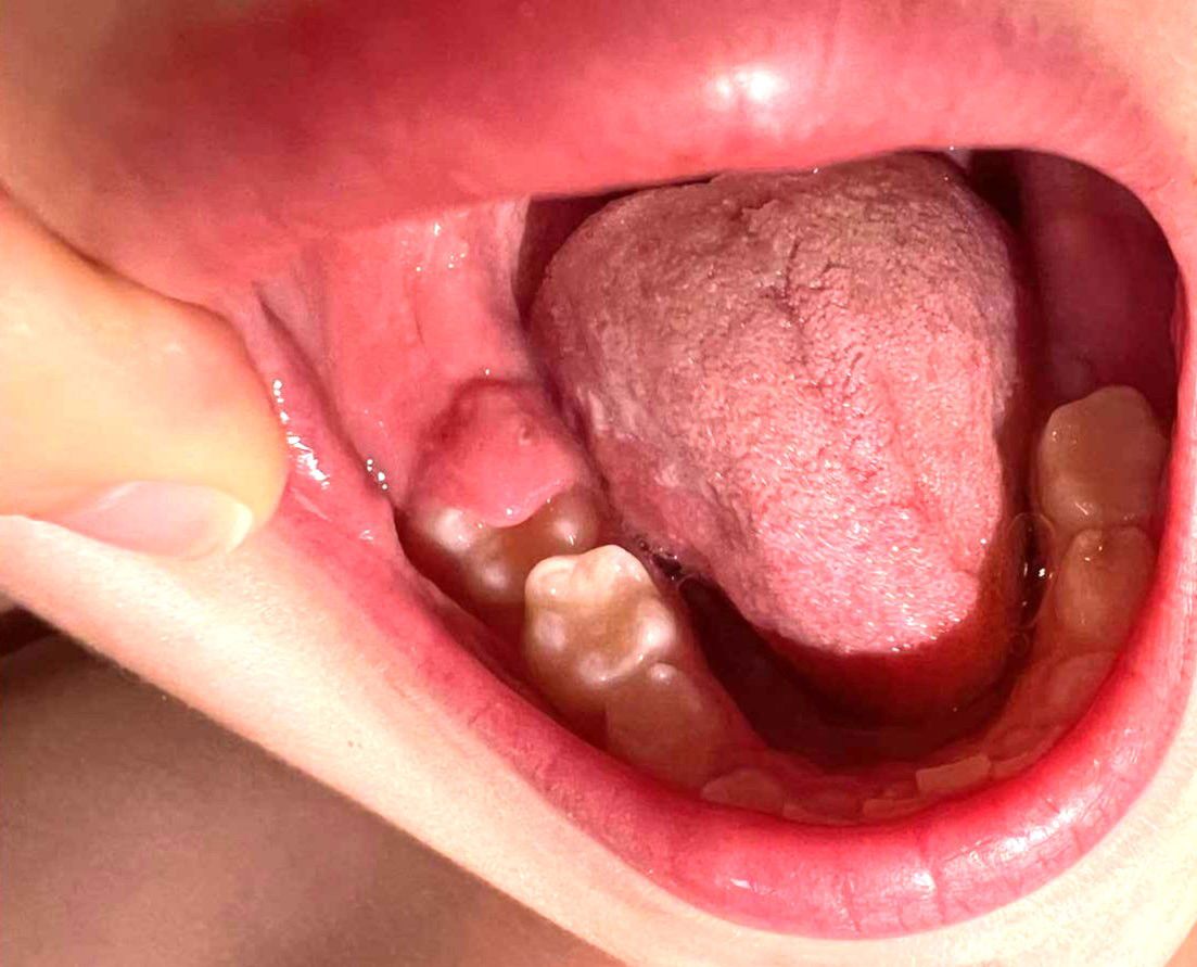 6-årstand på vej frem