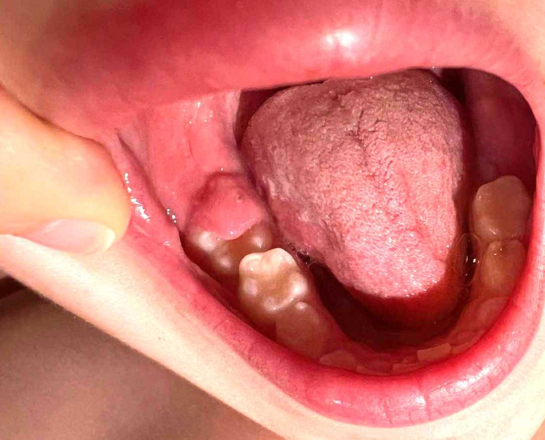 6-årstand på vej frem