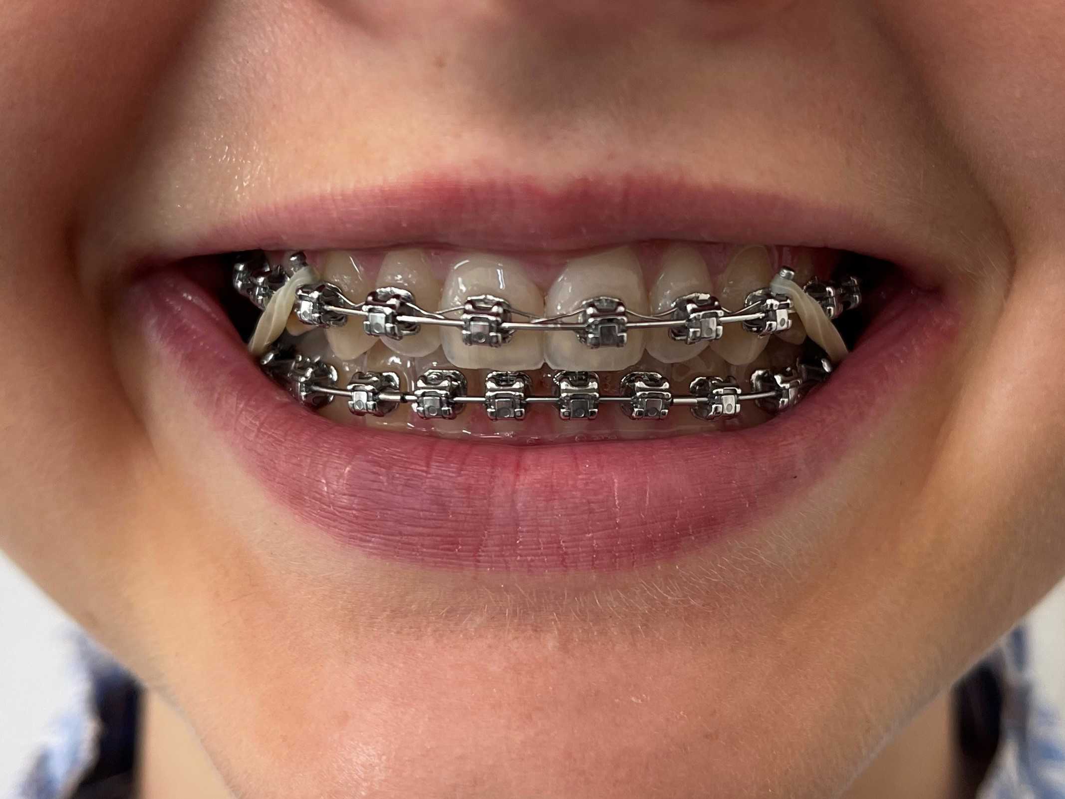 Tænder med fast bøjle på